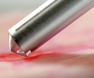 Аугментация НКР — Костные скребки — фото